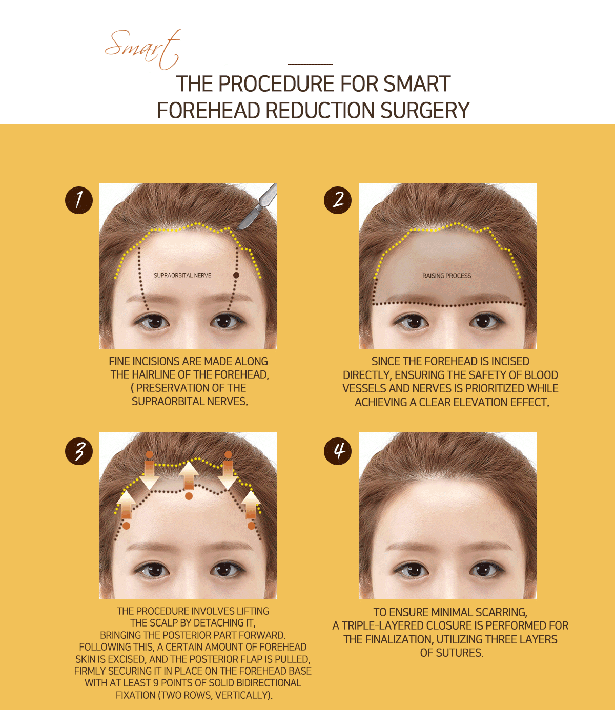 Smart Forehead Reduction Surgery