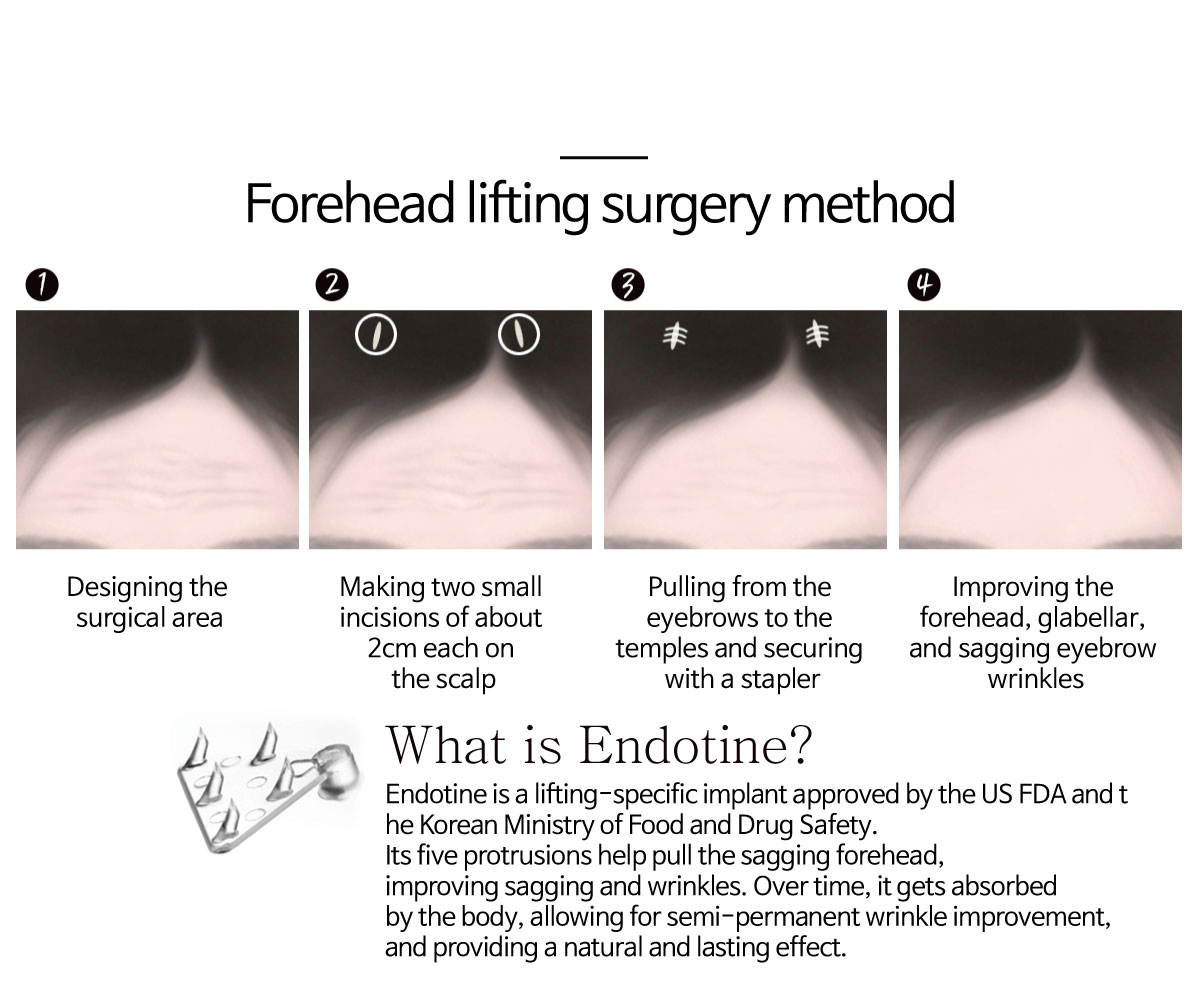 Forehead Lifting